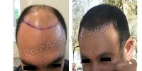 Man Hair Transplant 1