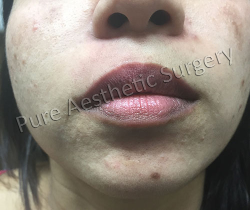 Lip augmentation surgery in delhi 