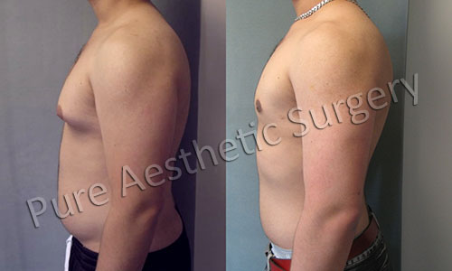 Before and After Gynecomastia Surgery
