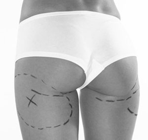 Buttock and Calf Reshaping
