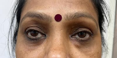 Eyelid surgery patient after treatment