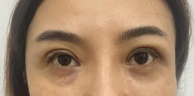 Patient 2 eyes before eyelid surgery
