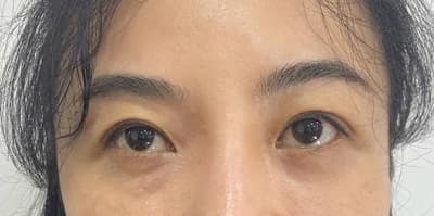Patient 2 eyes after eyelid surgery