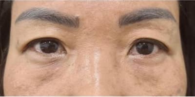 Patient 3 eyes before eyelid surgery