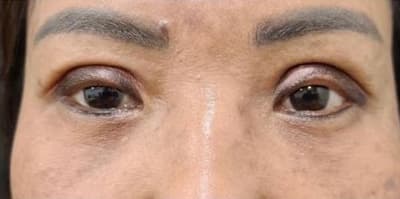Patient 3 eyes after eyelid surgery