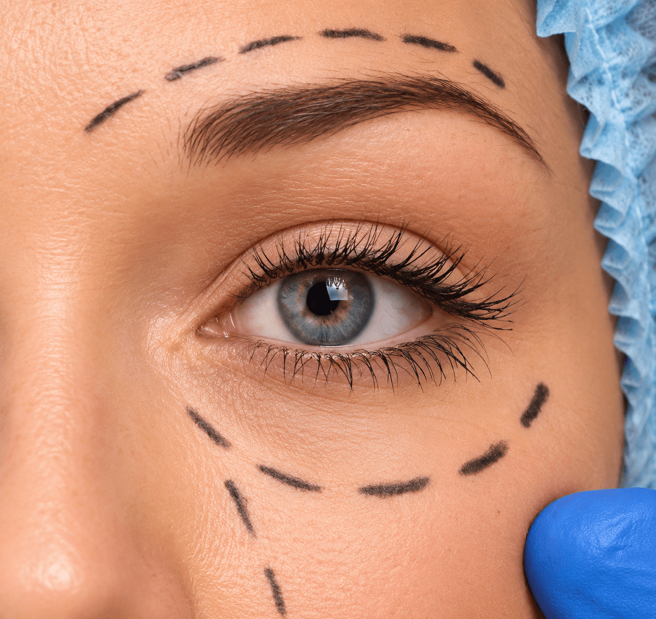 Blepharoplasty