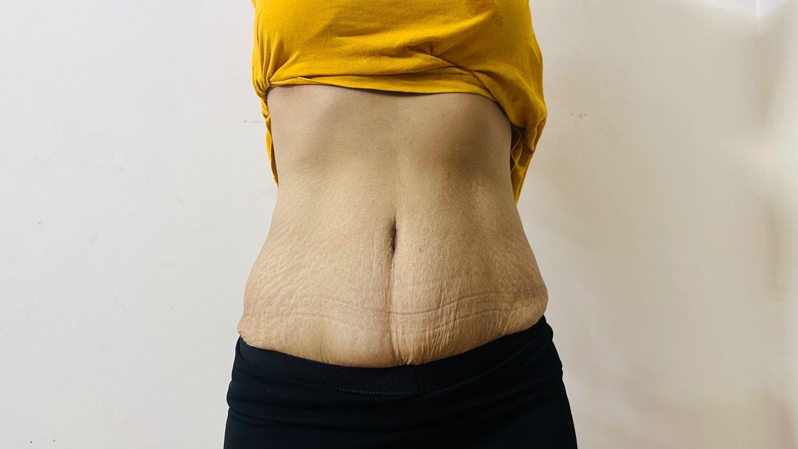 High-definition lipo-sculpture result showing athletic torso definition