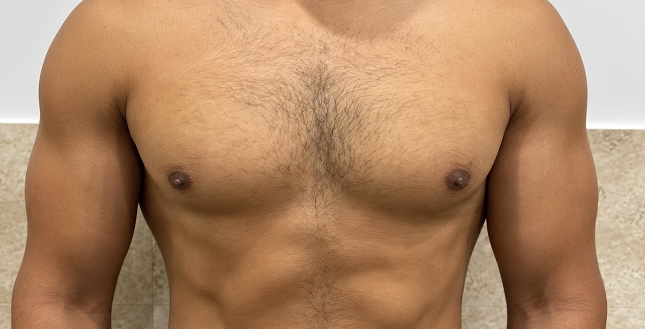 Gynecomastia patient after treatment