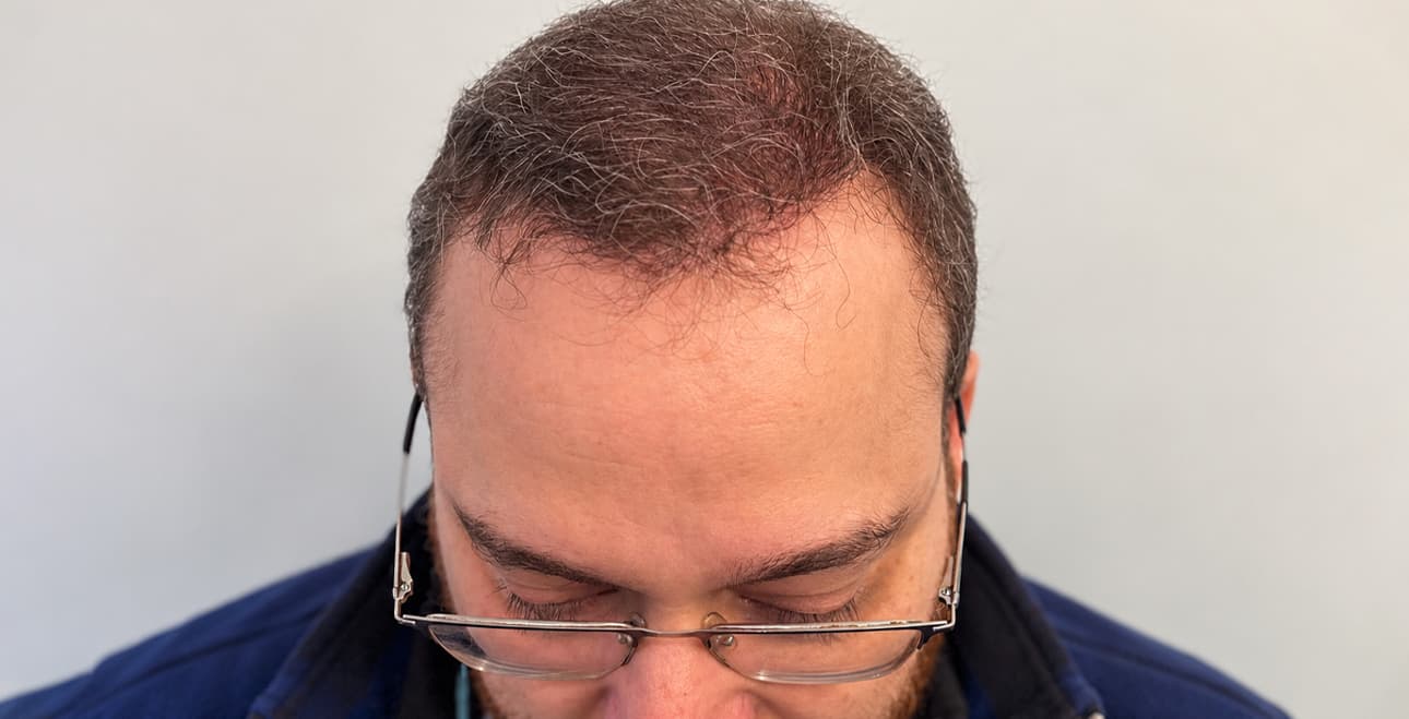 Hair transplant patient's restored hair coverage after treatment