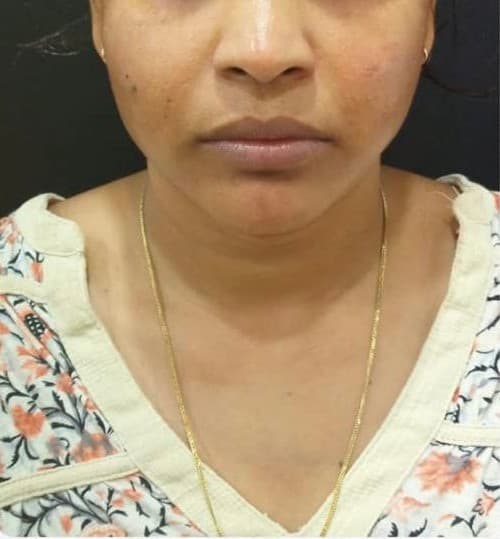 Thread lift patient after treatment