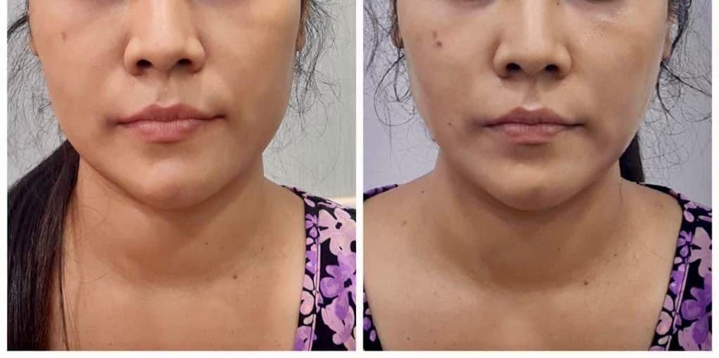 Thread lift patient 4, before and after