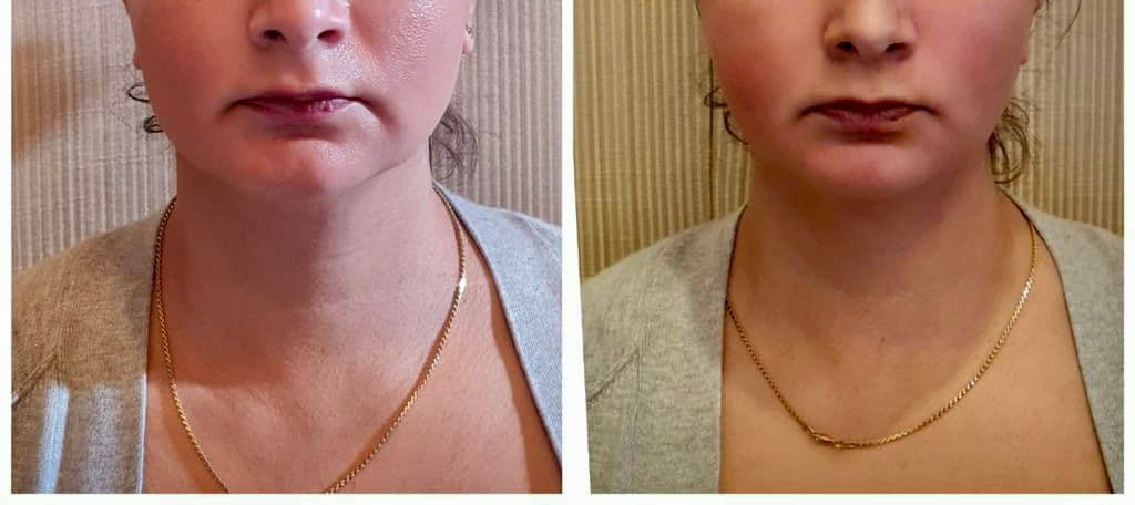 Thread lift patient 6, before and after
