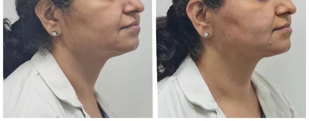 Thread lift patient 7, before and after