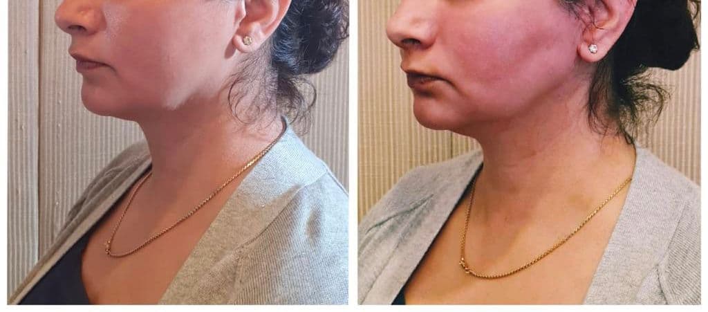 Thread lift patient 9, before and after