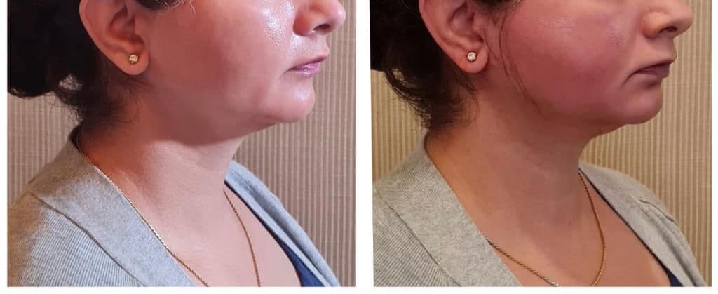 Thread lift patient 14, before and after