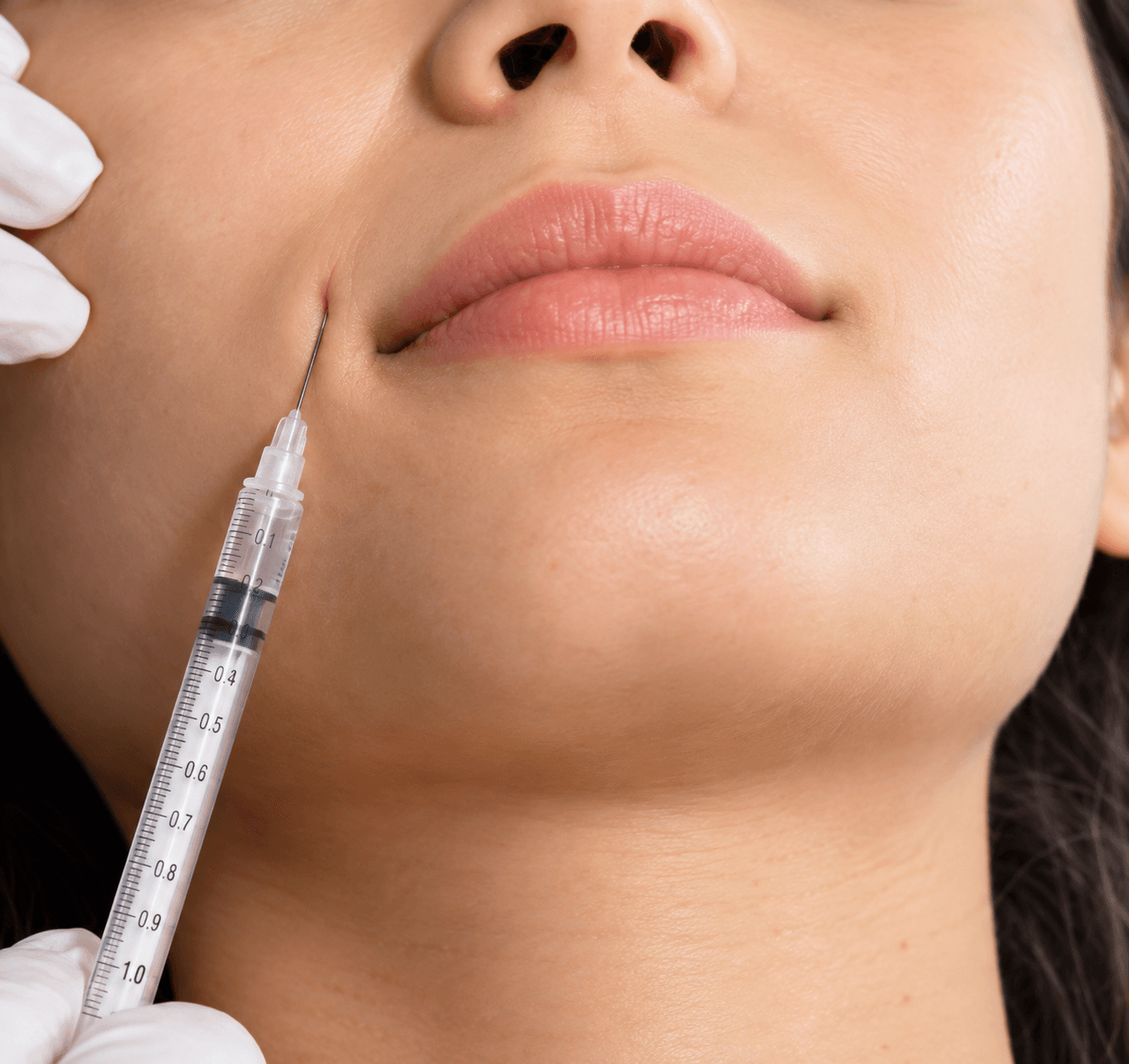 Sample image illustrating dermal fillers, after view